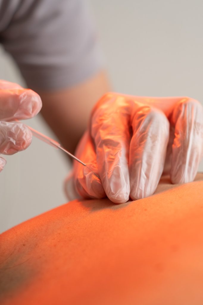 KINESIS OVIEDO FISIOTERAPIA y OSTEOPATIA EN OVIEDO tratamientos puncion seca 3