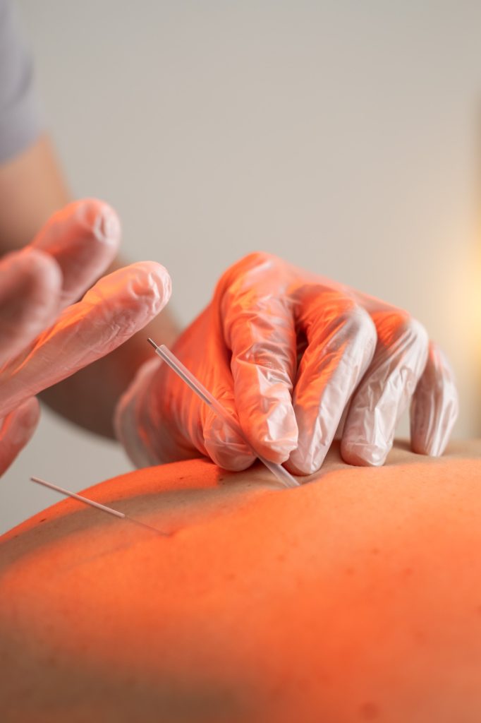 KINESIS OVIEDO FISIOTERAPIA y OSTEOPATIA EN OVIEDO tratamientos puncion seca 4