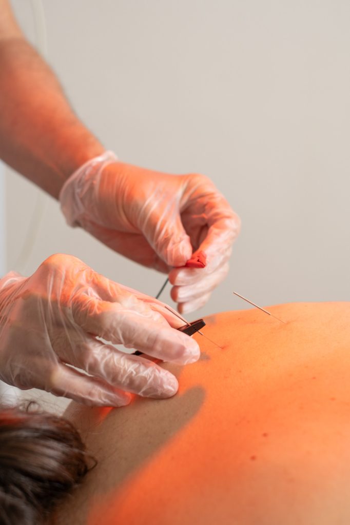 KINESIS OVIEDO FISIOTERAPIA y OSTEOPATIA neuromodulacion percutanea 1