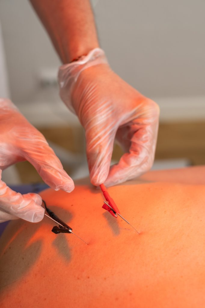 KINESIS OVIEDO FISIOTERAPIA y OSTEOPATIA neuromodulacion percutanea 2