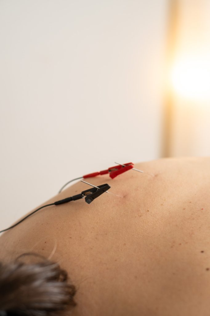 KINESIS OVIEDO FISIOTERAPIA y OSTEOPATIA neuromodulacion percutanea 3