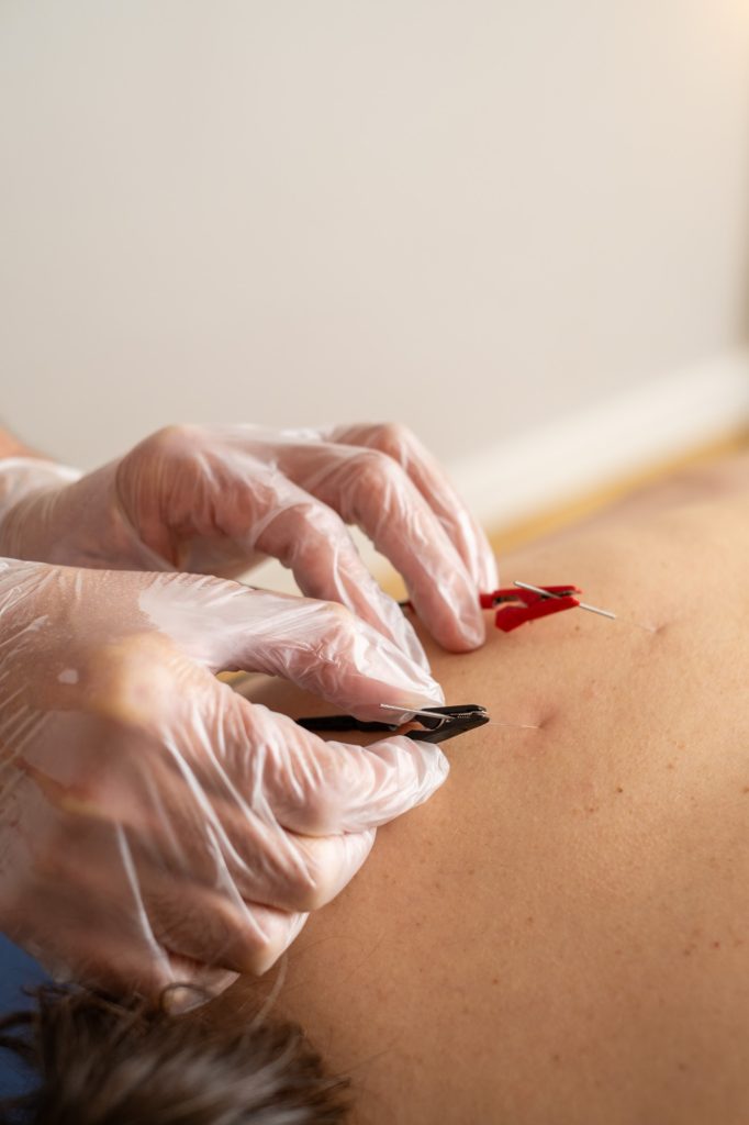 KINESIS OVIEDO FISIOTERAPIA y OSTEOPATIA neuromodulacion percutanea 4